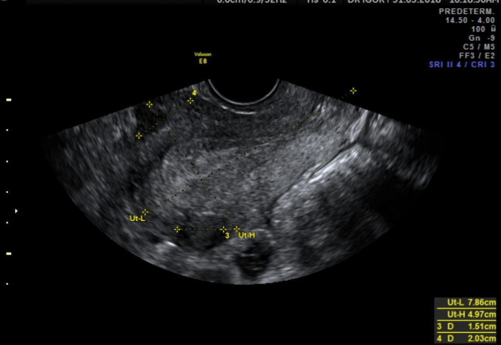 Ecografía Transvaginal Medicina Fetal Avanzada 5714